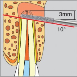 diamant chirurgie - D254 presentation