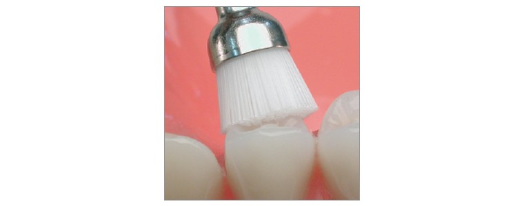 Polissage prophylactique