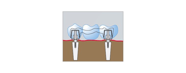Fraisage oxyde de zirconium