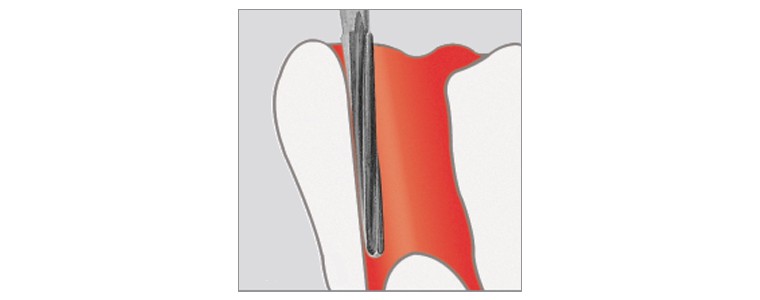 Fraises pour endodontie