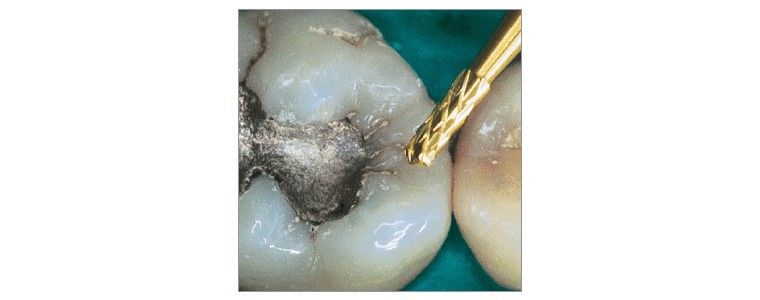 amalgam removers