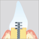 SYSTEMES DE TENONS