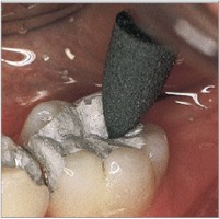 Polissage des amalgames