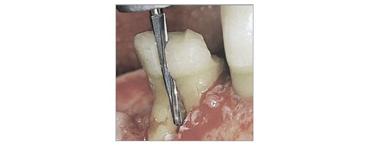 Instruments de chirurgie