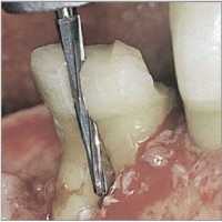 Instruments de chirurgie