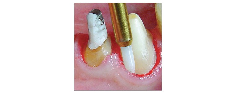 STT249 - STT250 Soft Tissue Trimmers