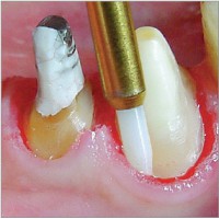 STT249 - STT250 Soft Tissue Trimmers