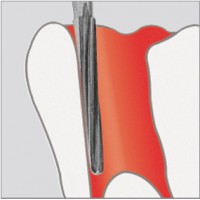 Fraises pour endodontie