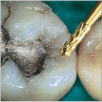 amalgam removers