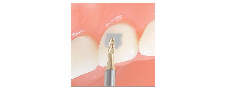 T21XR - retrait des résidus adhésifs, revêtement TiN