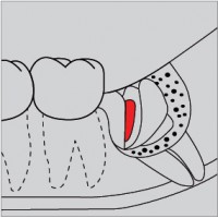 Surgery Diamond
