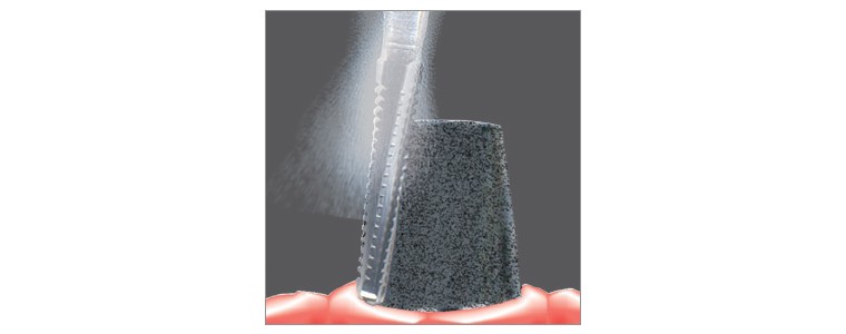 intraoral work on Titanium