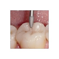 972 - Fraise occlusale ZrO2